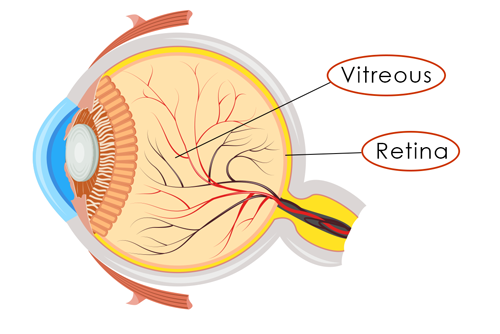Retinal Detachment diagram
