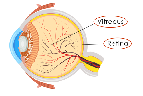 What is a Detached Retina?  Symptoms, Causes and Treatment