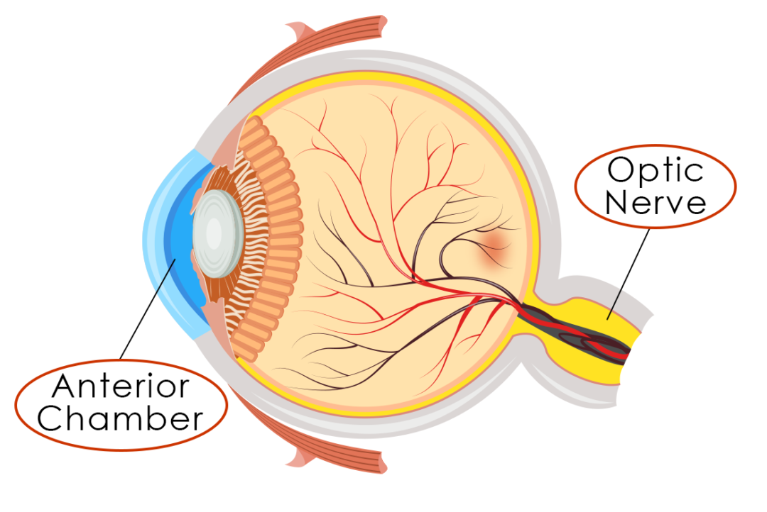 Glaucoma eye diagram optic nerve Eye Care Specialists Ophthalmology 