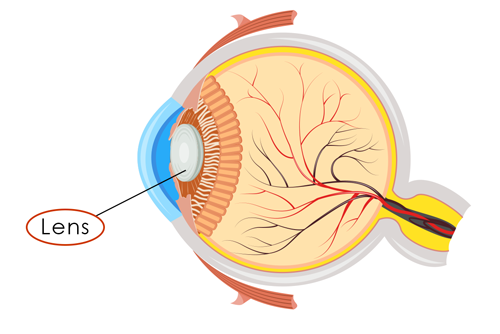 Cataract eye diagram